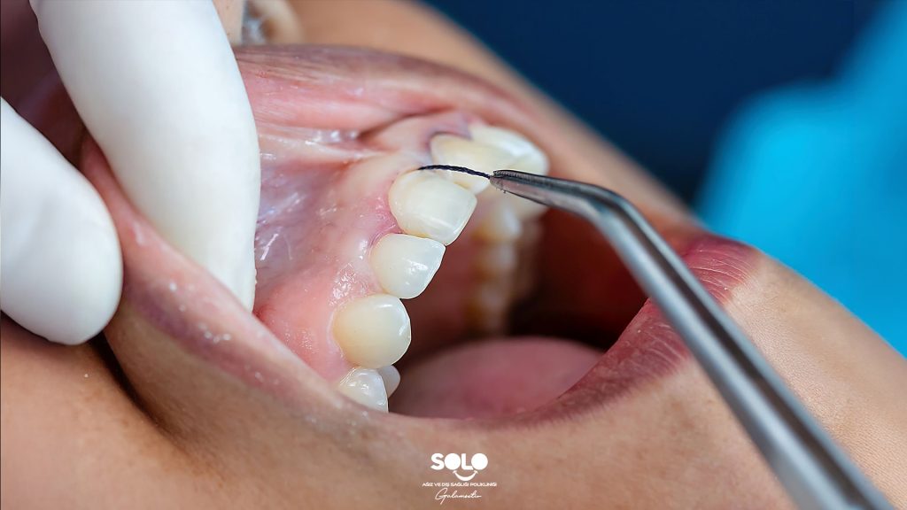 What Is Dental Curettage?