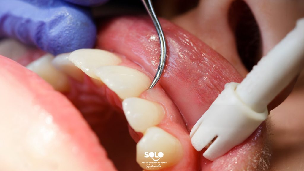 What Is Dental Curettage?
