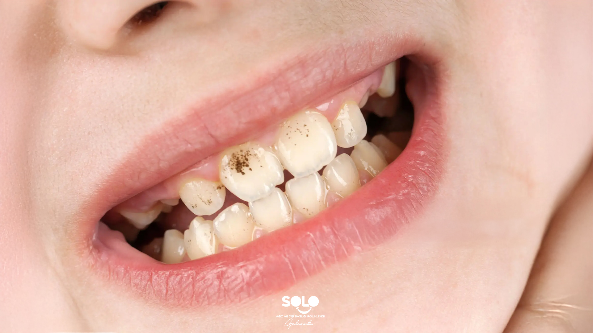 Diş Lekesi Neden Olur