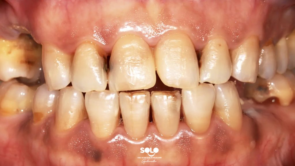 Diş Lekesi Neden Olur