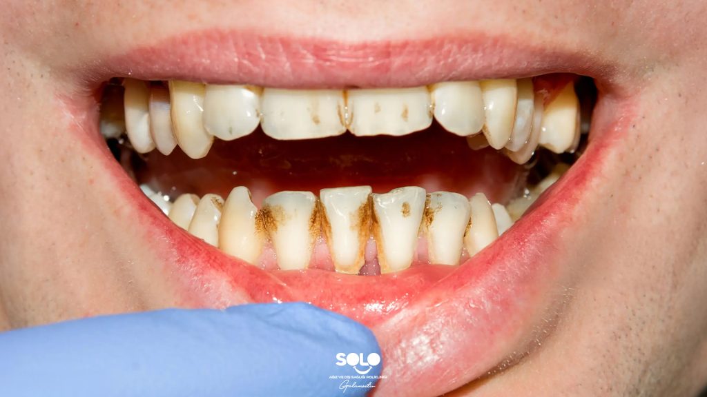 Diş Lekesi Neden Olur