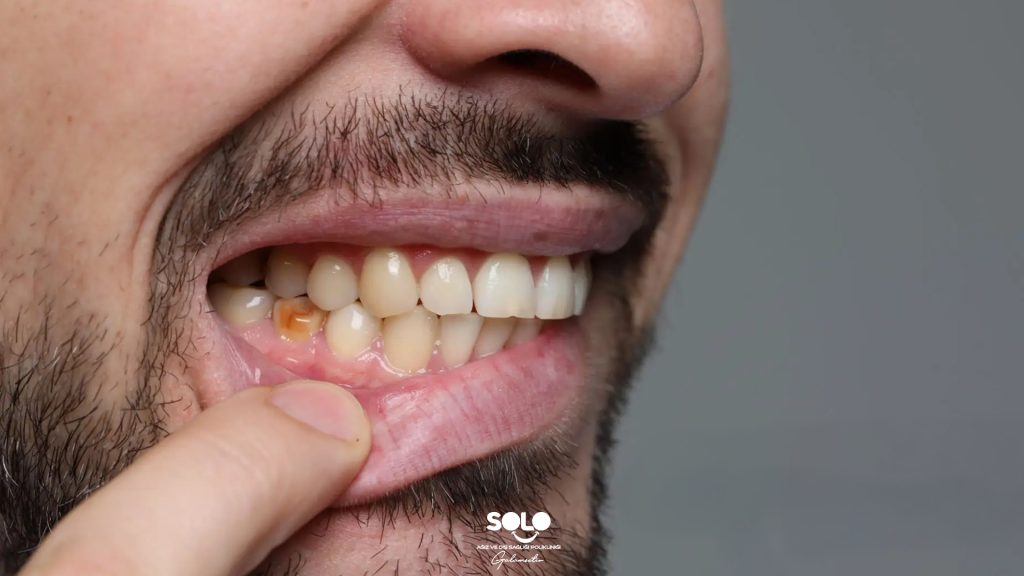 Diş Lekesi Neden Olur