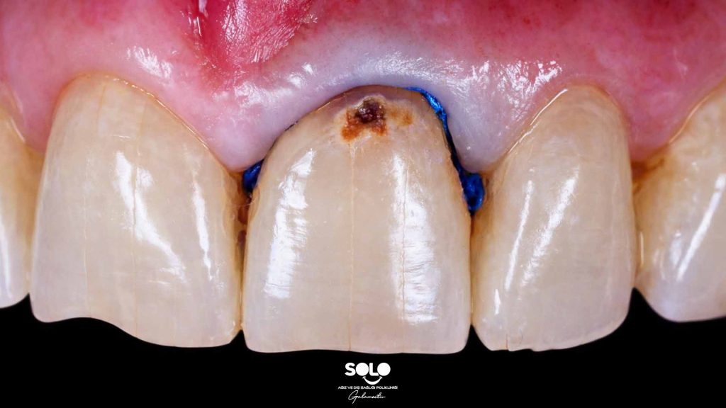 What Is a Dental Lesion
