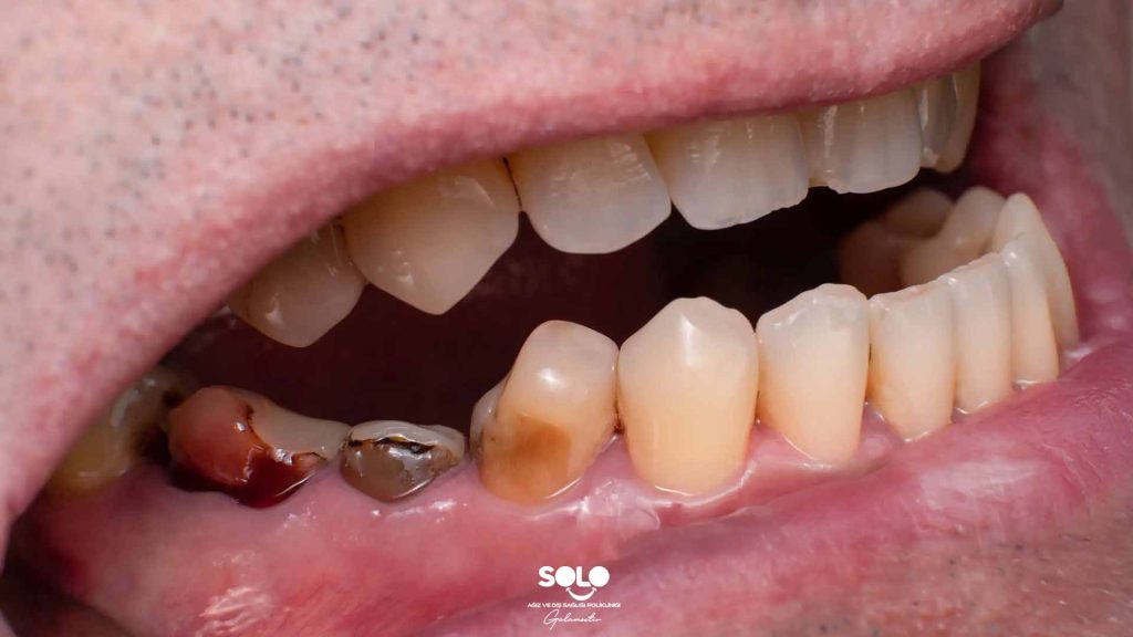 What Is a Dental Lesion