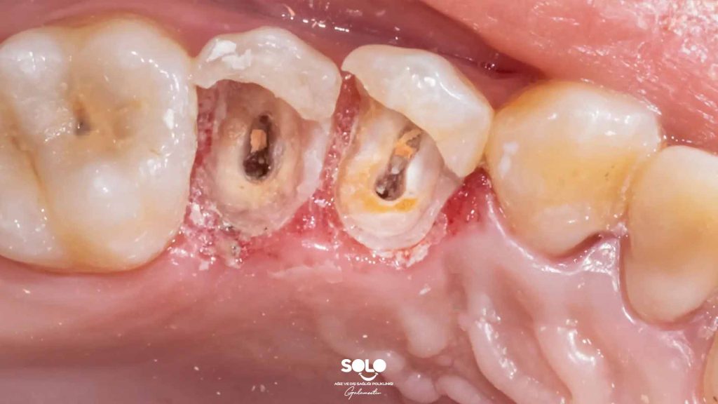 What Is a Dental Lesion